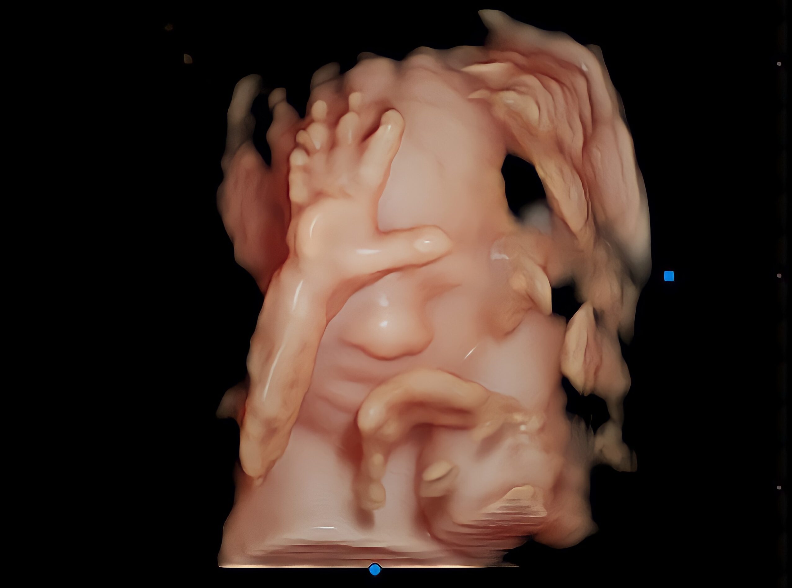 Baby's Hand in 3D 4D ultrasound
