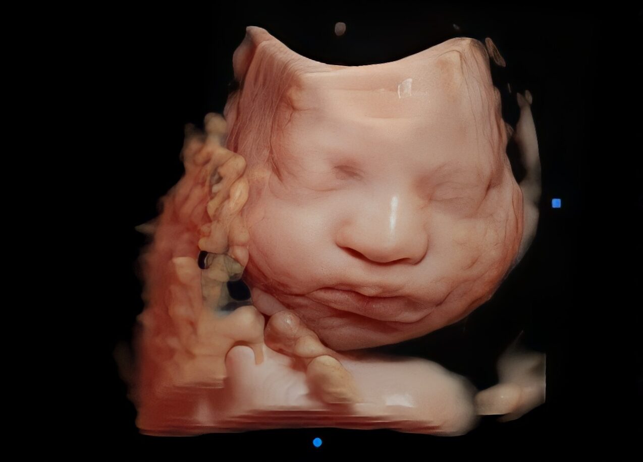 Baby's Face in 3D 4D ultrasound