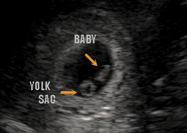 Early pregnancy ultrasound showing yolk sac and baby during in-home session in Forrest Hill, Maryland