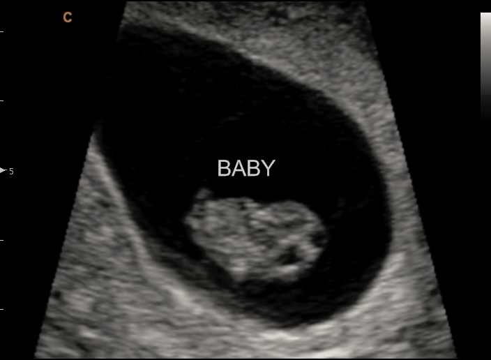 Early pregnancy ultrasound showing yolk sac and baby during in-home session in Delta, PA