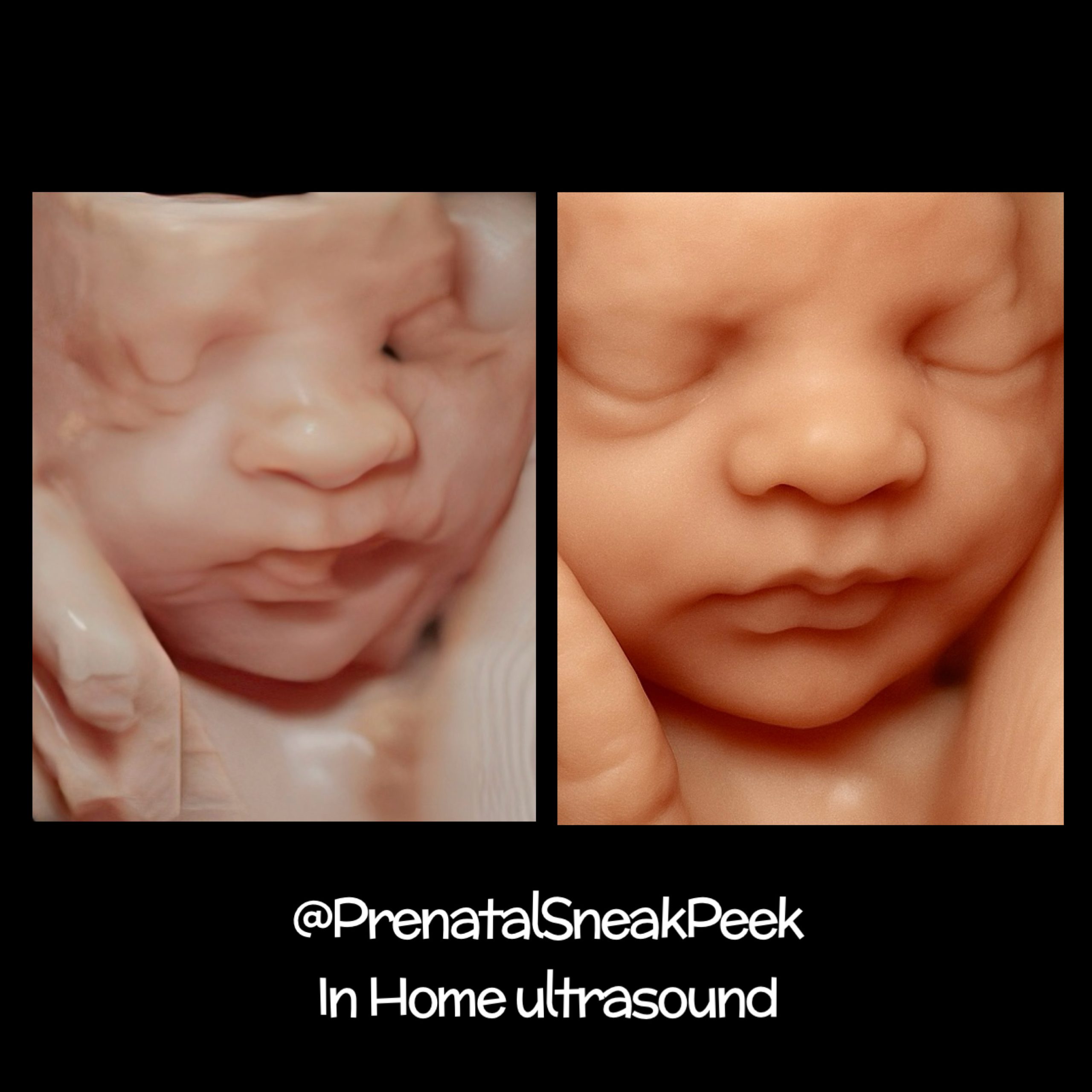 Enhanced 8k 3D ultrasound image of a baby’s face during in-home session in Bel Air, Maryland