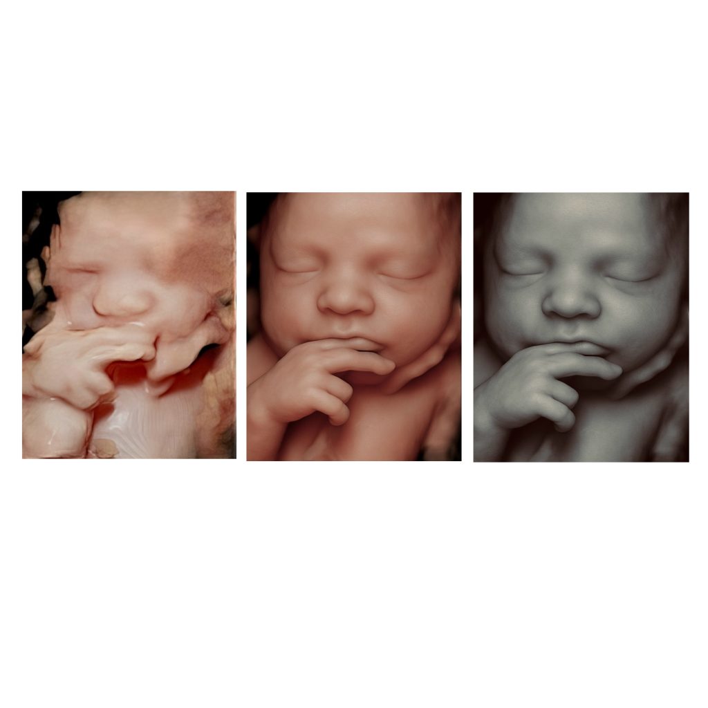 Ultrasound to enhanced baby face collage showing transformation from 3D image to lifelike preview.